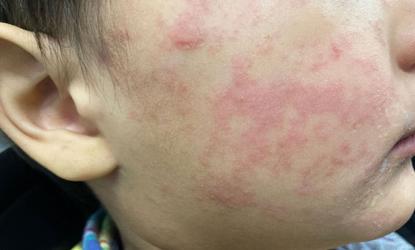 close up of a child's cheek with a red rash.