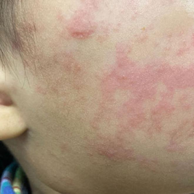 close up of a child's cheek with a red rash.